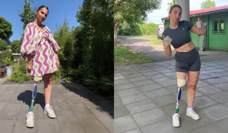 Marjolein met beenprothese in jurkje en sportoutfit