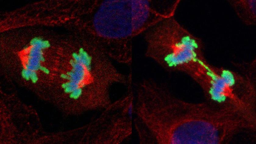 On the left a healthy cell in duplication phase. On the right a defective cell, lacking the protein Amber1, during duplication: the errors accumulated on the DNA induce the production of a thin strand of chromosomes (in bright green) that keeps the two daughter cells connected, preventing a proper distribution of genetic material. ( Credits Maiani, Miletti, Nature 04-2021) On the left a healthy cell in duplication phase. On the right a defective cell, lacking the protein Amber1, during duplication: the errors accumulated on the DNA induce the production of a thin strand of chromosomes (in bright green) that keeps the two daughter cells connected, preventing a proper distribution of genetic material.